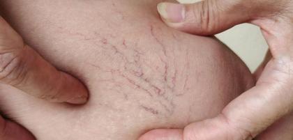 Kiedy żylaki stają się poważnym zagrożeniem dla zdrowia i życia?