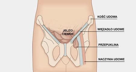 przepuklina pachwinowa