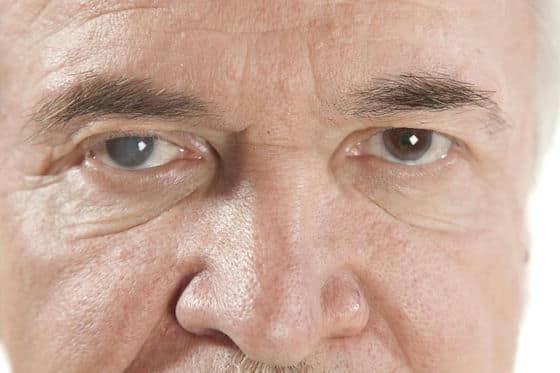 Jaskra – przyczyny, objawy i leczenie